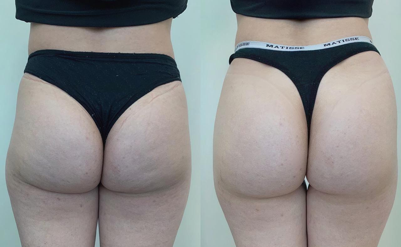 Antes e depois com glúteos mais arredondados e pele mais uniforme
