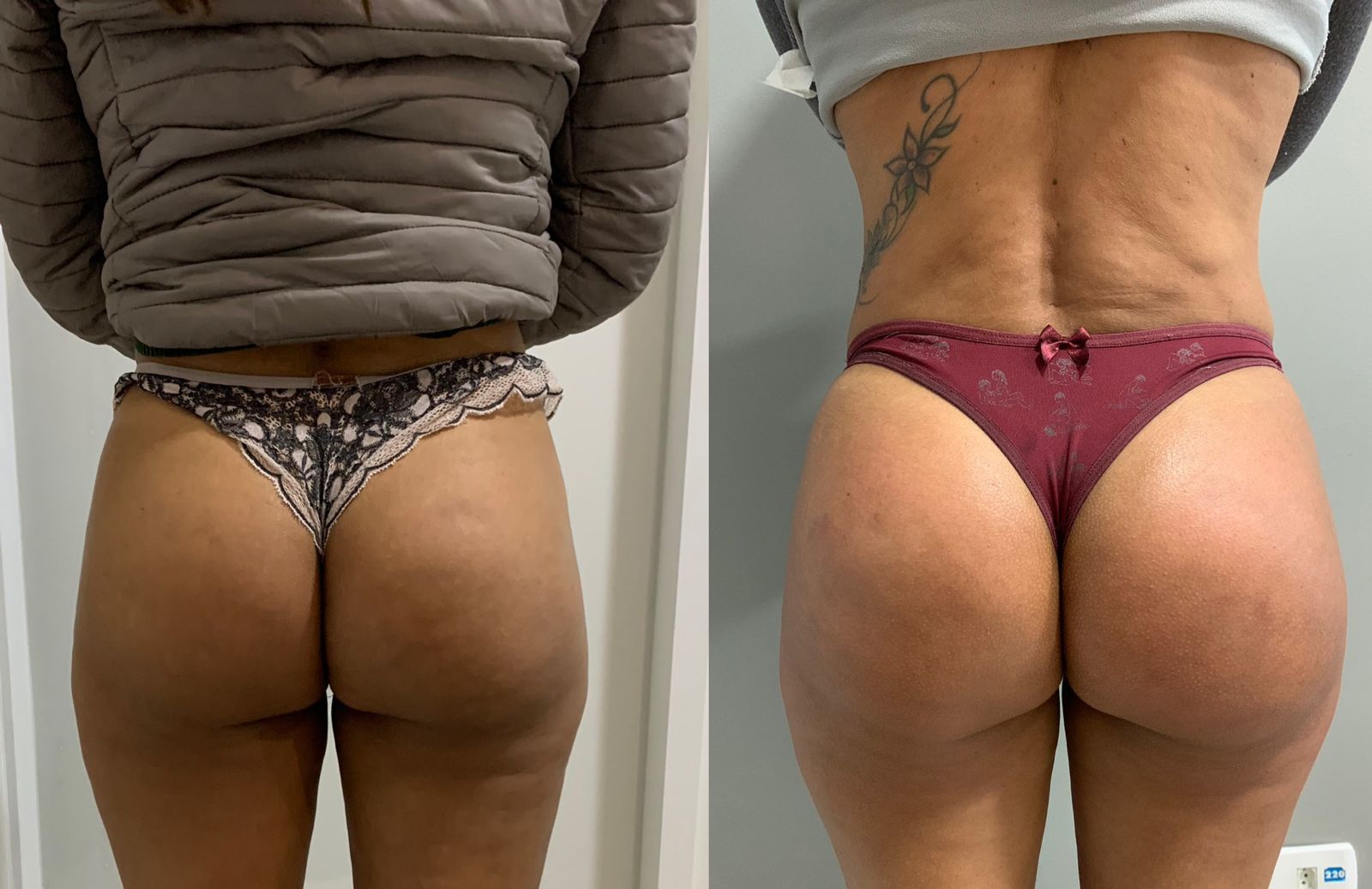 Antes e depois com melhora de volume e contorno glúteo
