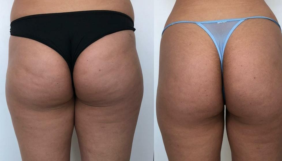 Antes e depois com melhora do formato e transição mais suave da região glútea